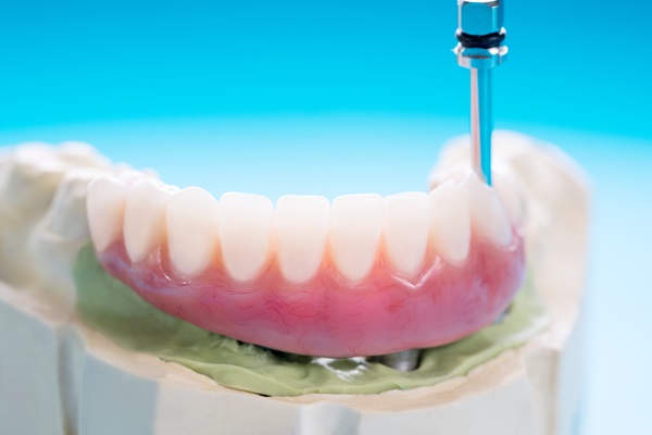 Recovery Tips After An Implant Supported Dentures Procedure